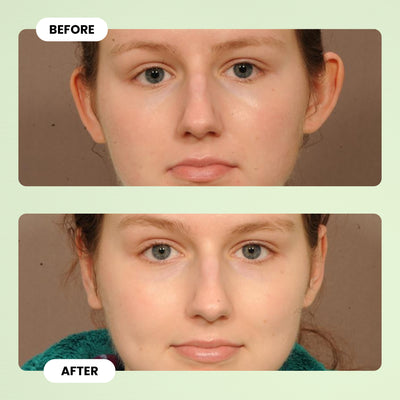 EarFix™ Invisible Ear Corrector