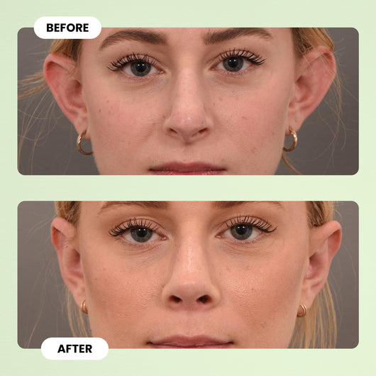 EarFix™ Invisible Ear Corrector