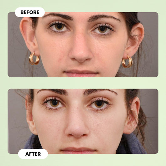 EarFix™ Invisible Ear Corrector